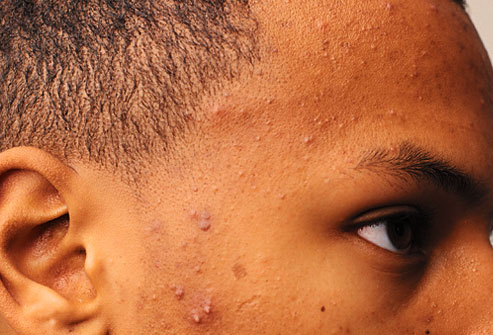 Acne: 10 Tips to Avoid Break Outs