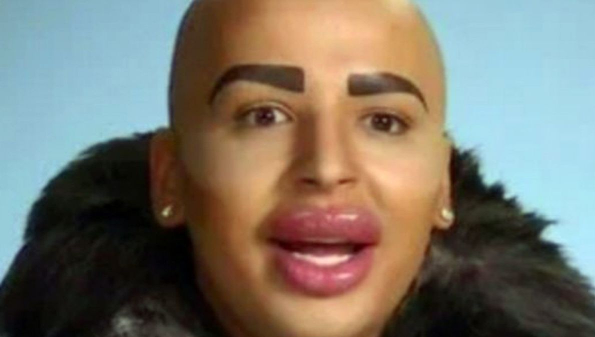 Lip King: How Obsession With Kim Kardashian Led to Demise of Lookalike