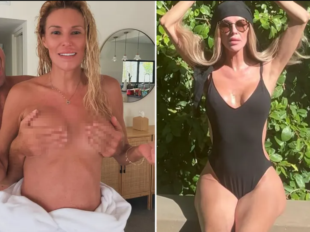 TV Personality, Brandi Glanville, Recounts How Breast Implants Caused Facial Paralysis (Graphic Photos)
