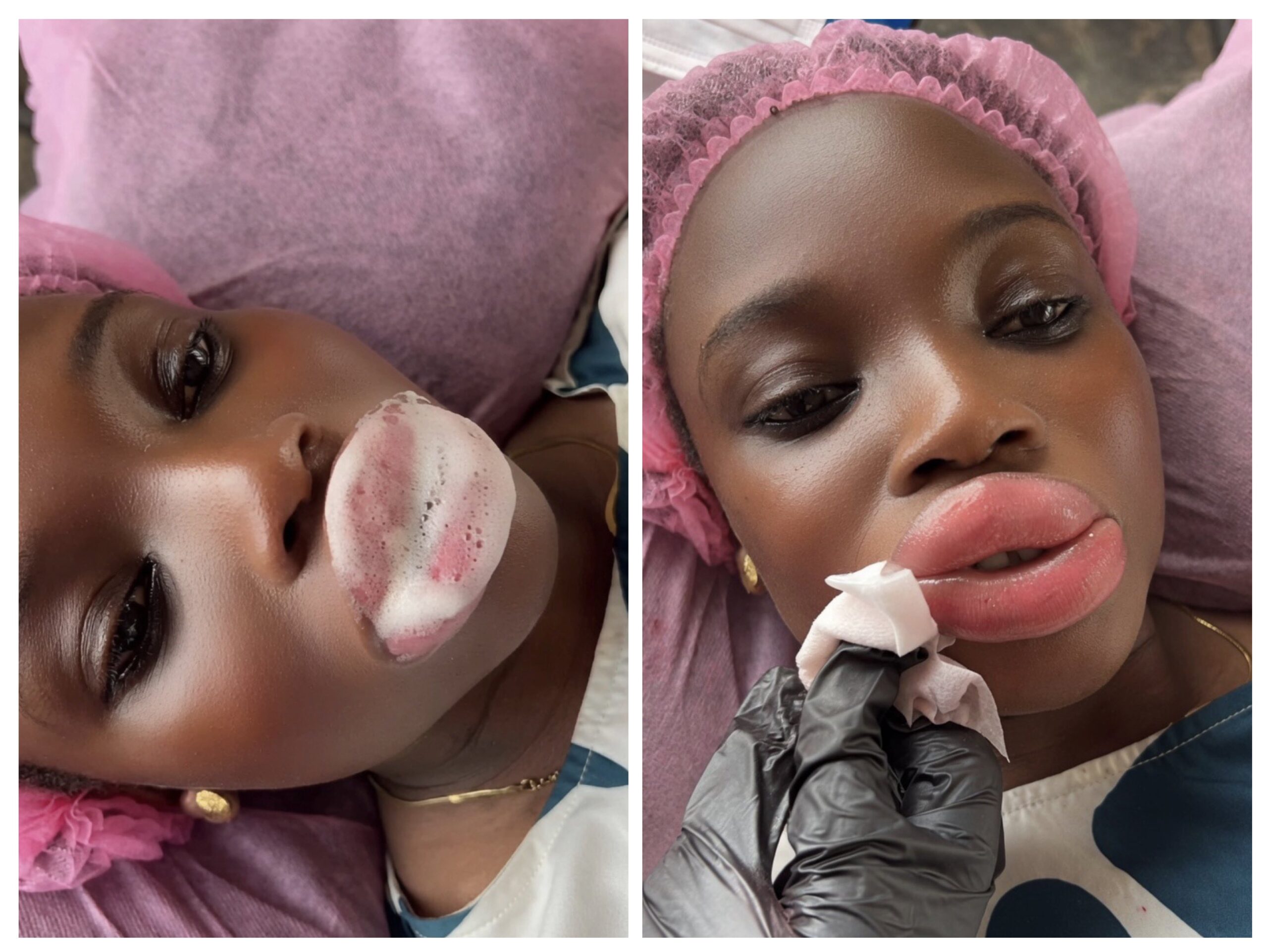 Beauty Standard or Stupidity: Nigerians Discuss Use of Lip Fillers