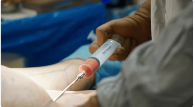 Beyond the Trend: The Dangerous Health Consequences of Brazilian Butt Lifts